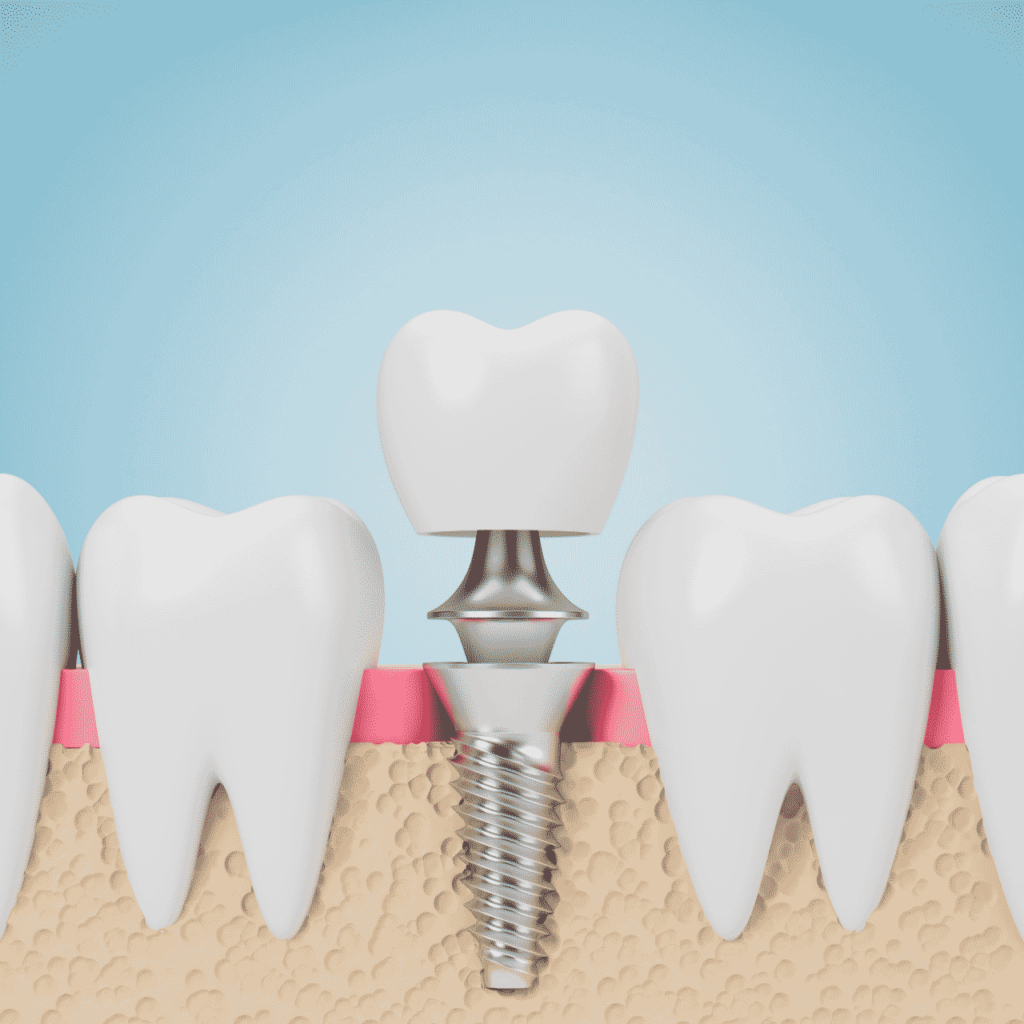 diagram of a dental implant